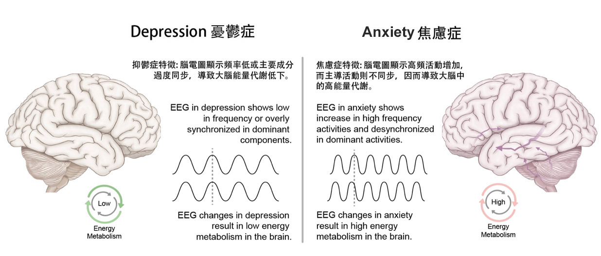 憂鬱症特徵及焦慮症特徵
