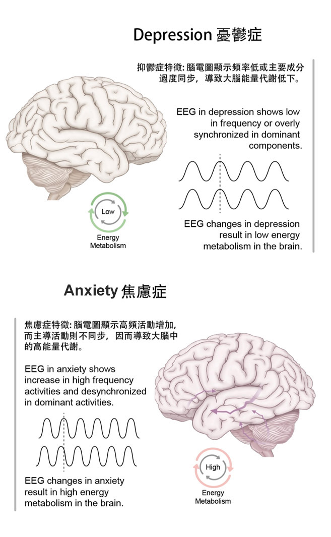 憂鬱症特徵及焦慮症特徵