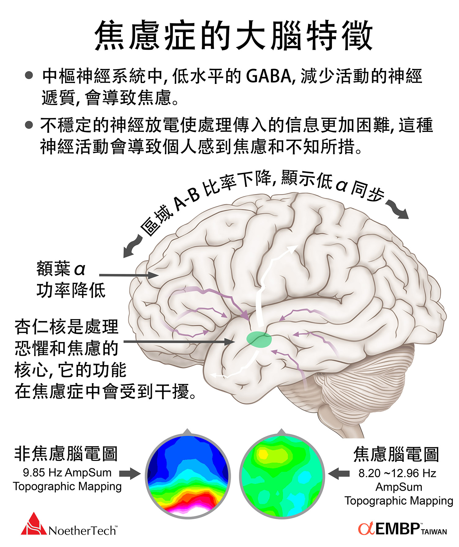 焦慮症的大腦特徵