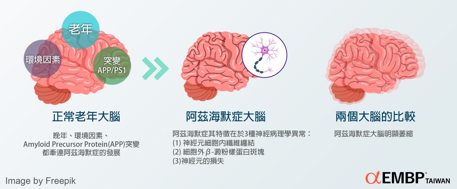 阿兹海默症的大腦