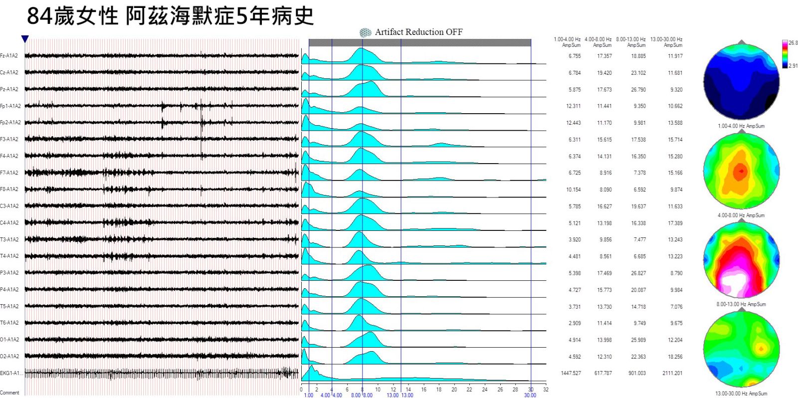 84歲女性 阿茲海默症5年病史