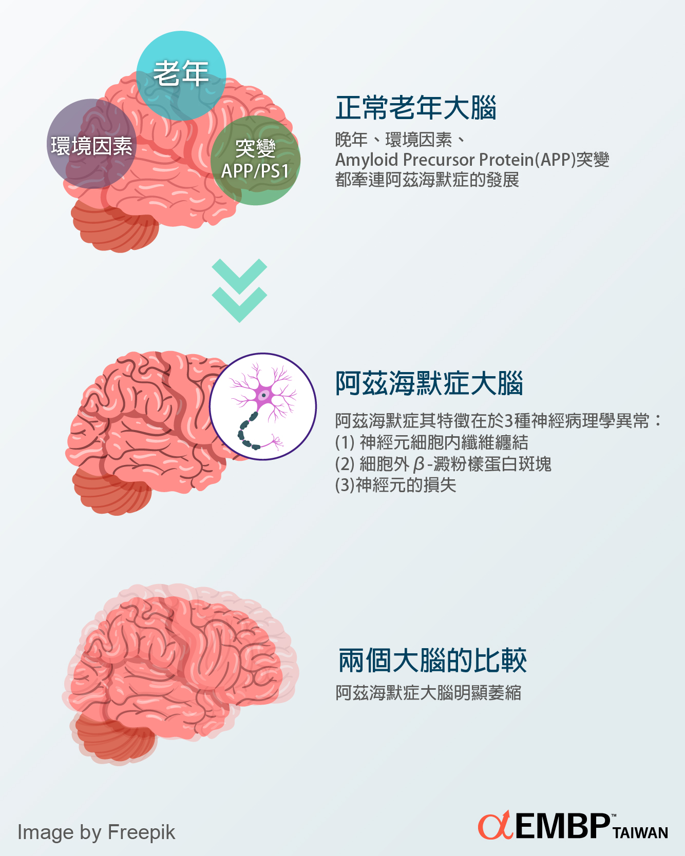 阿兹海默症的大腦